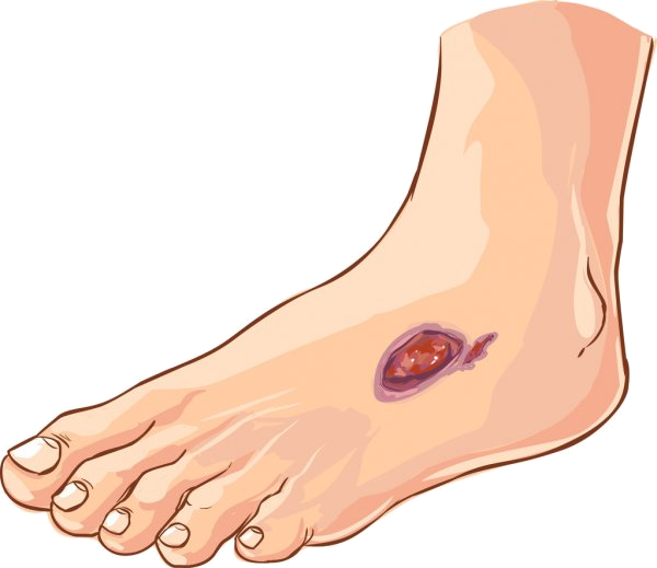Best Diabetic foot ulcer and Gangrene treatment in Aurangabad - Jaju Clinic